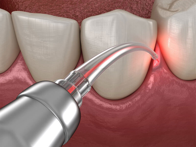 An image depicting a dental laser device being used on a tooth during a dental procedure, with the red light of the laser visible and a close-up view showing the precision tool in action.