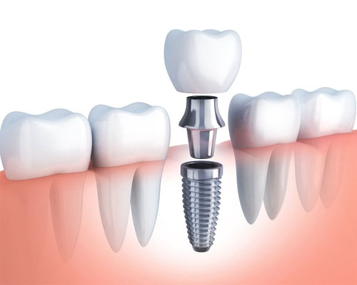 The image shows a set of human teeth with one tooth having a dental implant screwed into it, displayed against a red background.