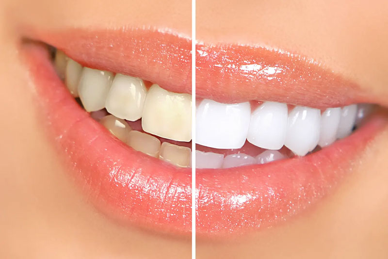 The image shows a close-up of a person s face with a bright smile, highlighting the difference between natural teeth and dental veneers.